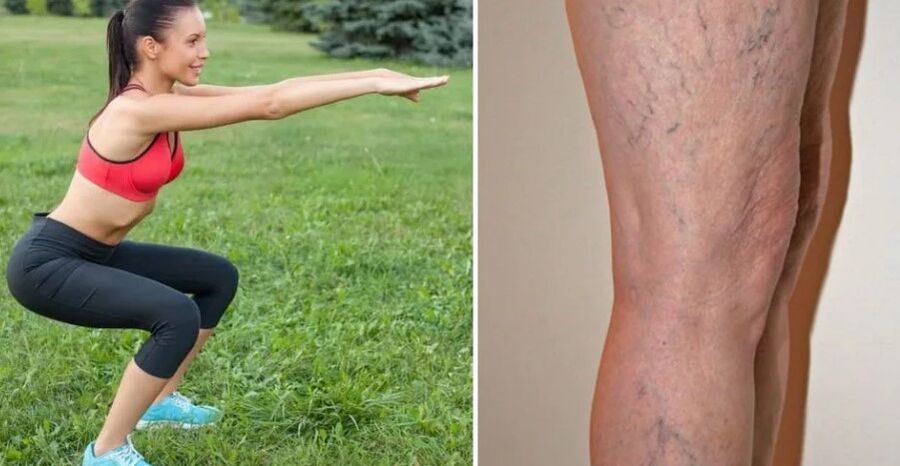 Legs for varicos