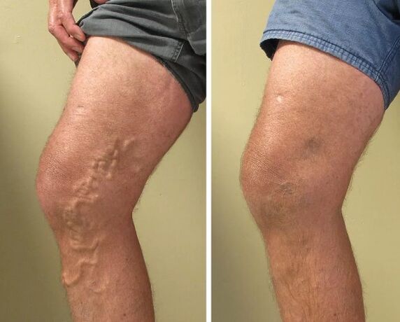 Varikoos veins before and after treatment